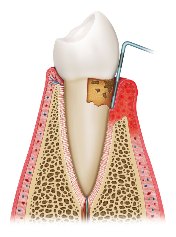 歯髄の除去